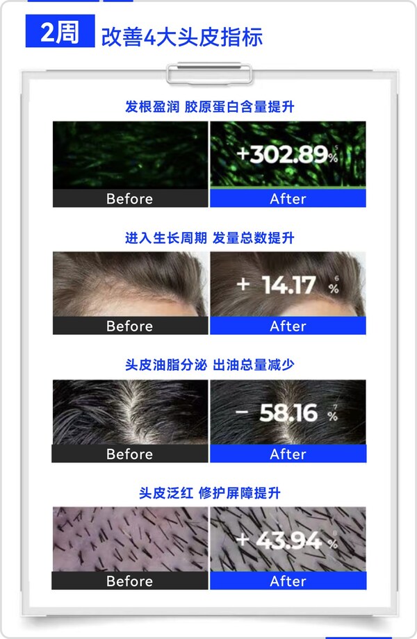 晶泰科技AI 研發(fā)平臺(tái)開發(fā)的小分子Remeanagen? 和多肽 AquaKine?聯(lián)用配方改善頭皮四大指標(biāo)，有效固發(fā)防掉發(fā)